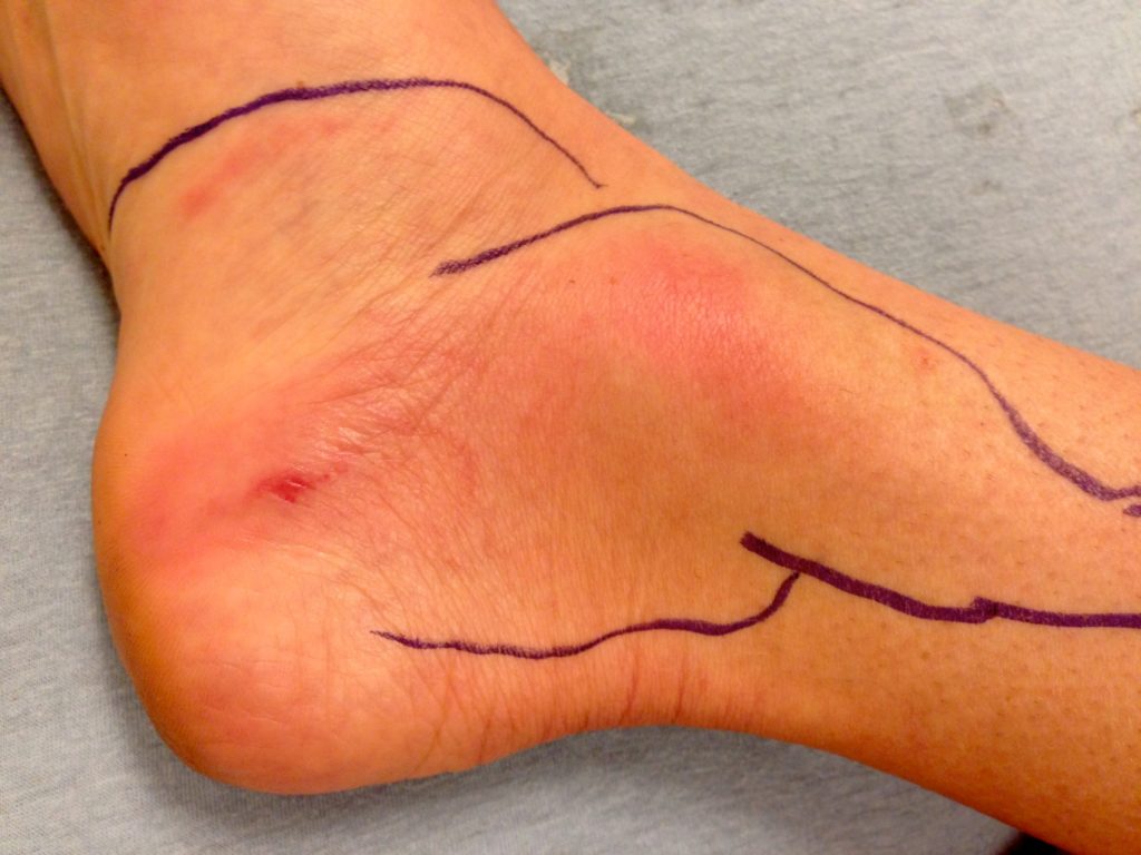 Blood Poisoning Causes, Symptoms And Other Risk Factors