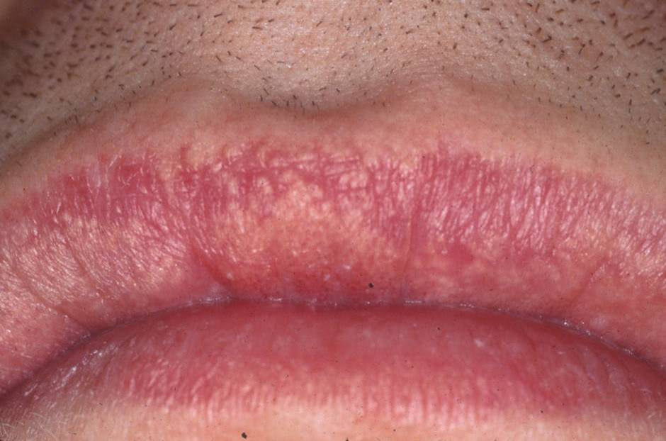 Fordyce Spots On Lips Treatment Apple Cider Vinegar And Honey