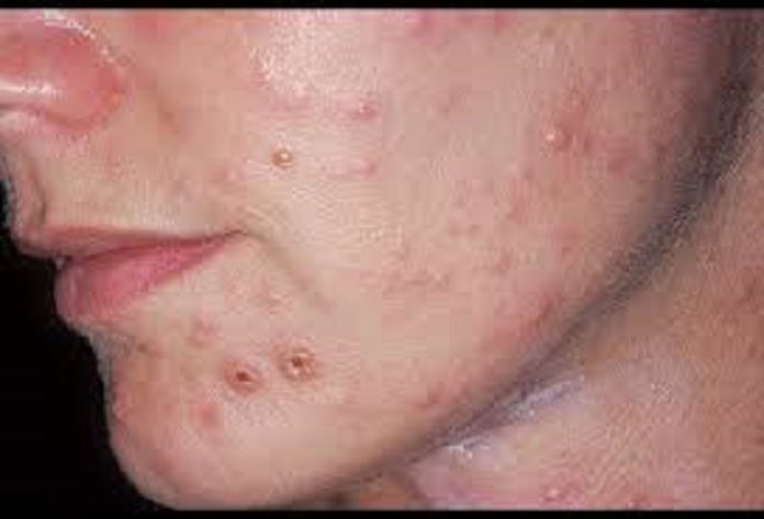 fungal infection home remedy