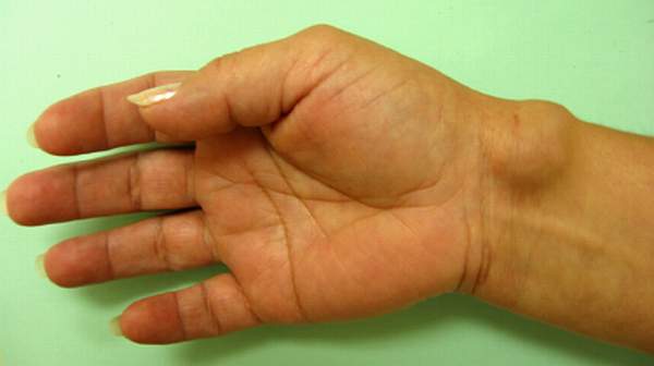 Home Remedy Ganglion Cyst