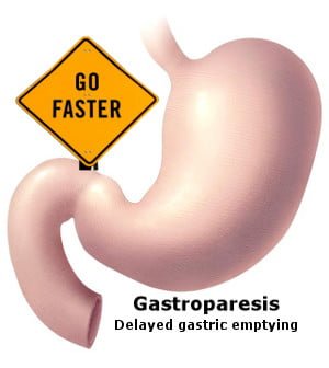 Gastroparesis is a condition in which the spontaneous movement of the muscles in our stomachs is not functioning normally.