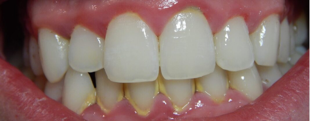 Gingivitis: Causes And Symptoms