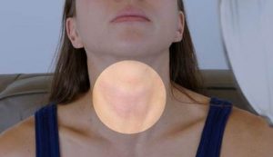 goiter