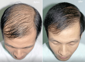 Natural Methods To Cure Baldness And Hair Regrowth
