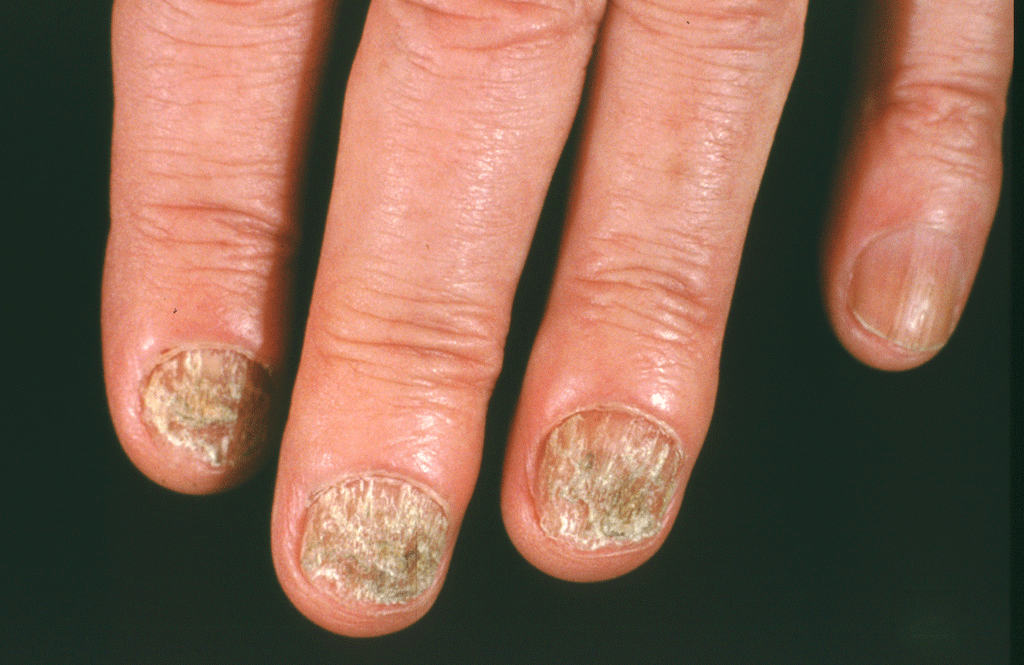 Nail fungus