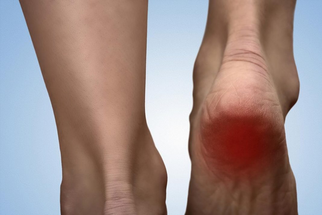 Milk and coconut oil can help in speedy treatment of heel spurs Natural cures for heel spurs