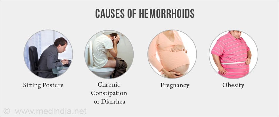 Лечение геморроя у беременных. Геморрой причины возникновения. Причины появления геморроя. Причины геморроя возникновения геморроя. Предпосылки возникновения геморроя.