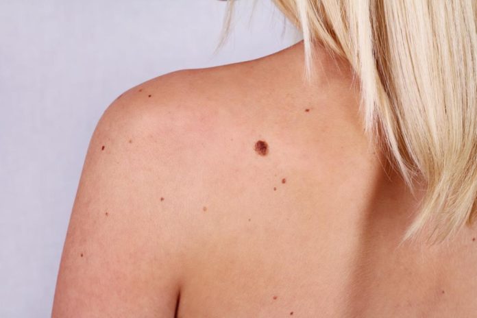 home remedies for moles