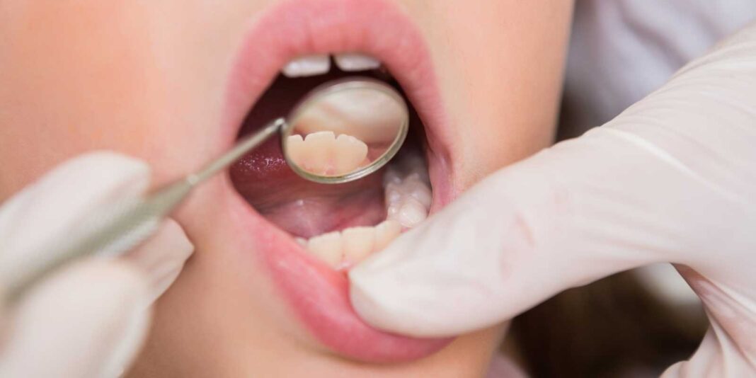Best 15 natural remedies for a tooth infection