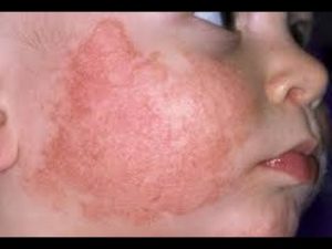  fungal infection home remedy