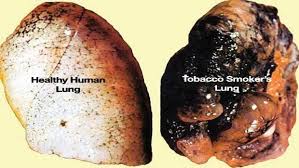 Lung cancer - types, symptoms, causes and other risk factors causes and symptoms of lung cancer