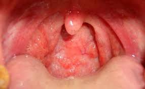Laryngitis