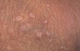 genital warts natural cure