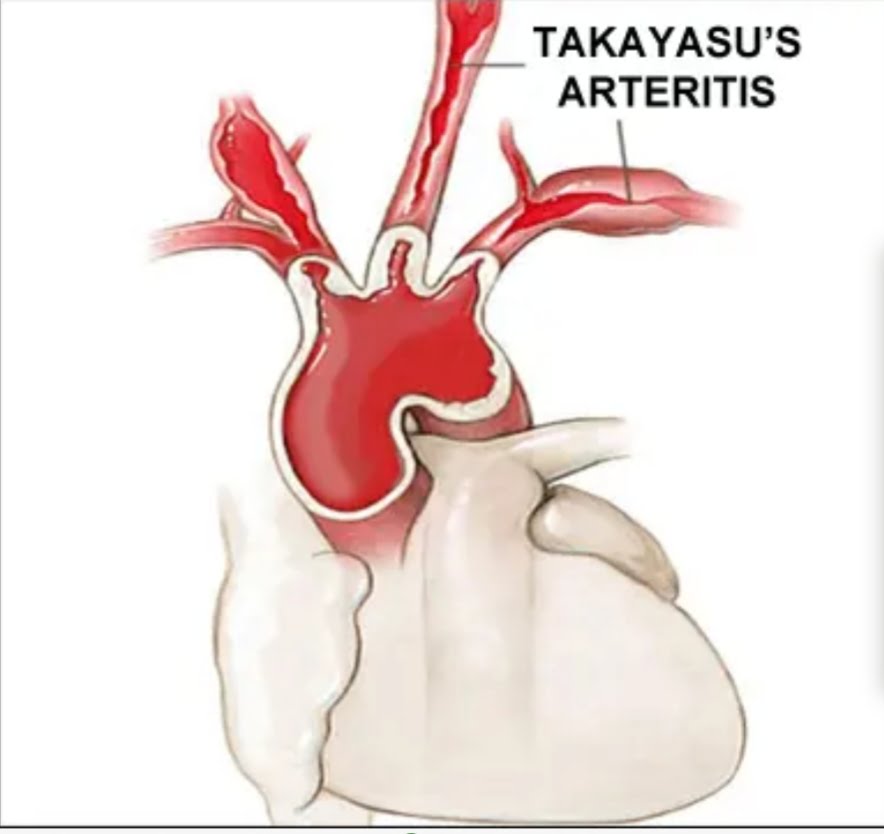 Takayasu's Arteritis