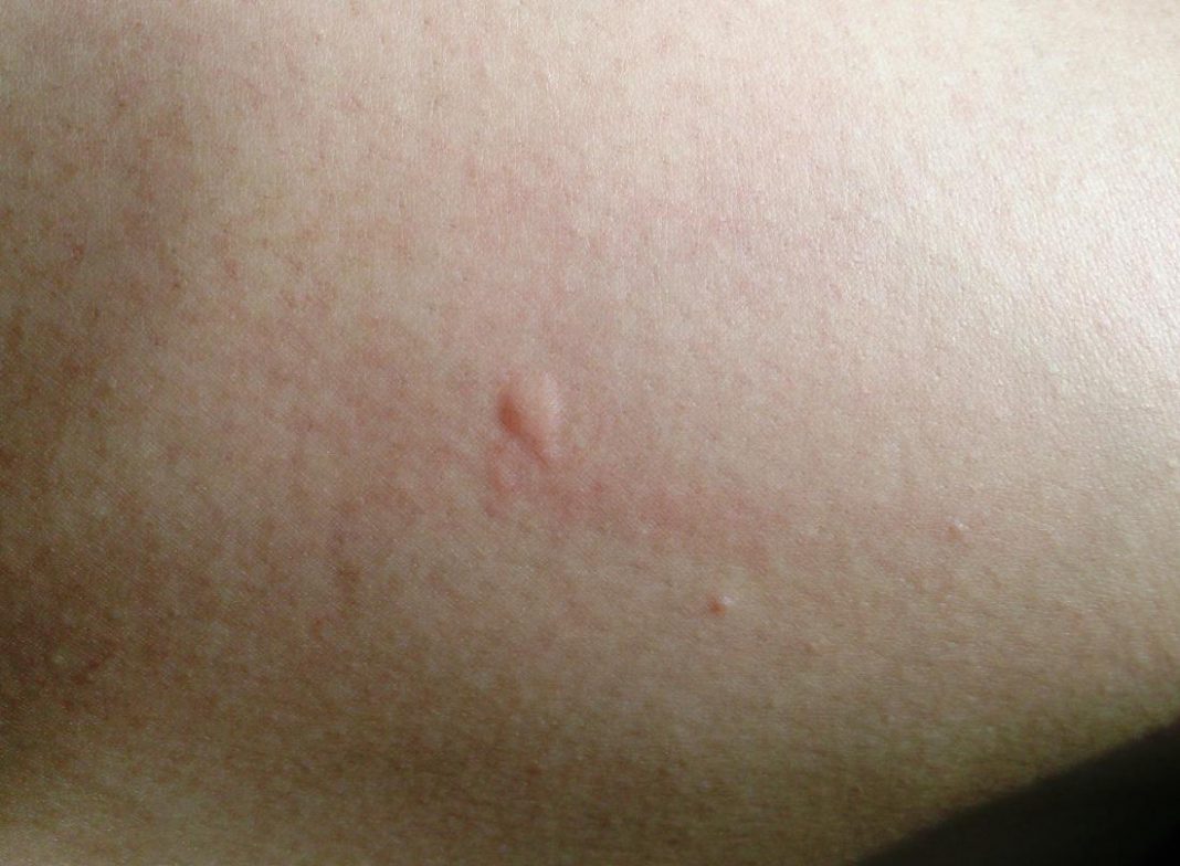 Insect Bites Symptoms, Causes & Top 04 Types