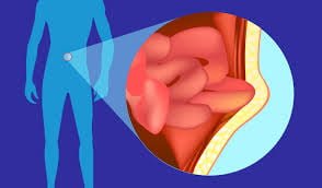 Inguinal hernia – Symptoms, causes and risk factors