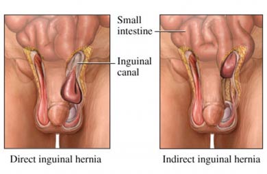 inguinal hernia surgery