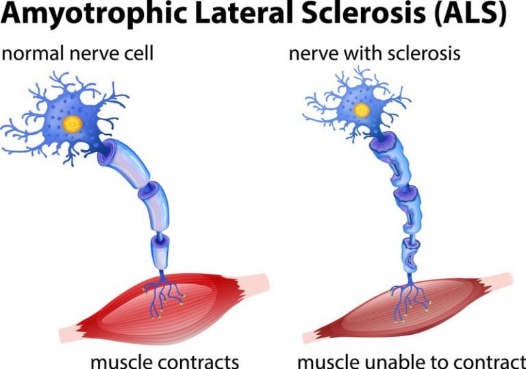 Amyotrophic Lateral Sclerosis (ALS) - Symptoms And Causes