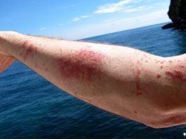 jellyfish sting pictures