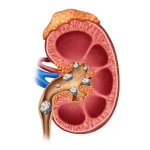 kidney stones causes types