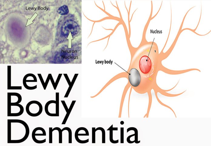 lewy body dementia