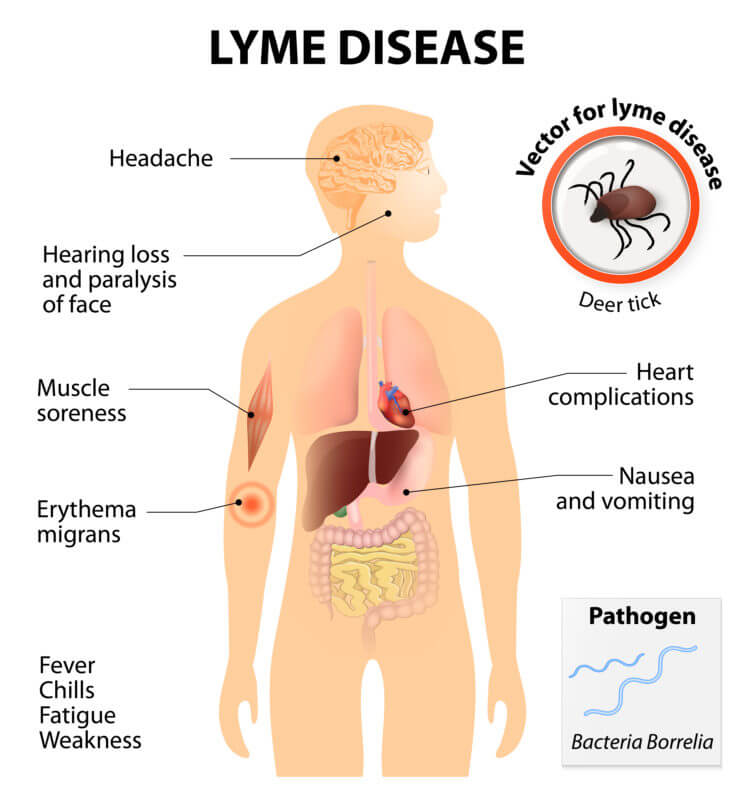 Natural treatment for Lyme disease