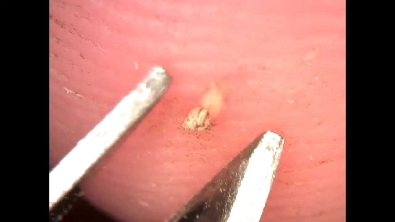 Splinters Causes, Symptoms And Other Associated Risk Factors