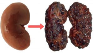 Kidney disease