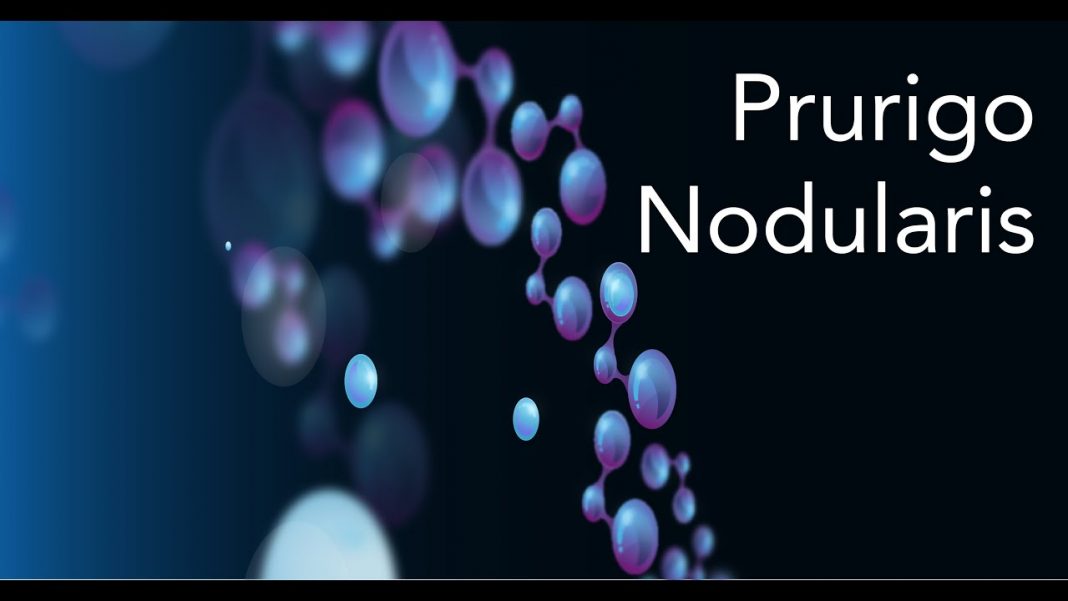 Natural treatments and remedies for prurigo nodularis Prurigo nodularis - Natural Treatments and Home Remedies
