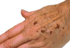 Age spots home remedy and selected best natural treatments age spots home remedy