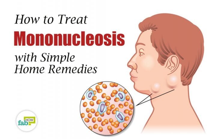 mononucleosis treatment home remedy