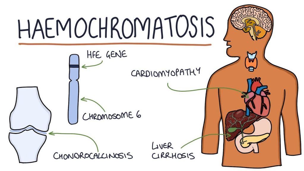 hemochromatosis