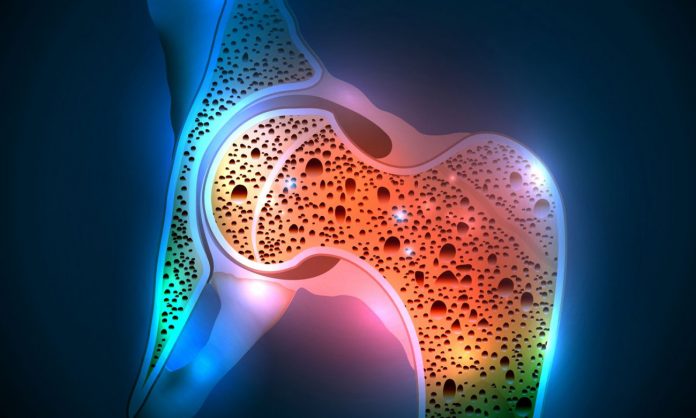 osteoporosis