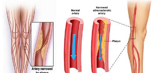 peripheral artery disease treatment