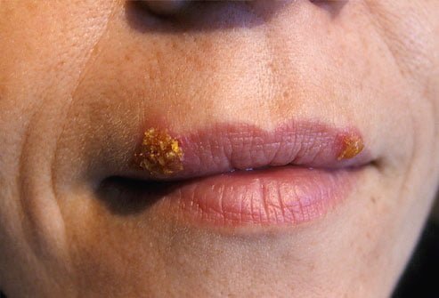 Cold sores home remedy and treatment cold sores home remedy