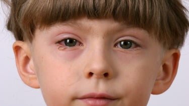 Natural cures for eye infections, eye infection home remedy