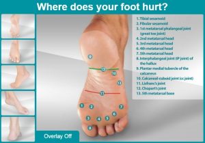 Avoid getting overweight to prevent plantar fasciitis (heel pain) plantar fasciitis causes