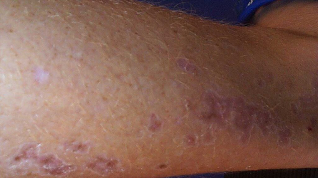 porokeratosis dermoscopy