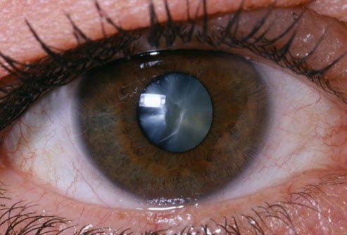 Eye infections - causes, symptoms and different types Eye infections