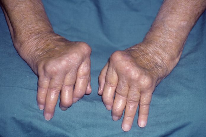 osteoarthritis treatment natural