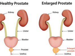 prostate enlargement natural cures