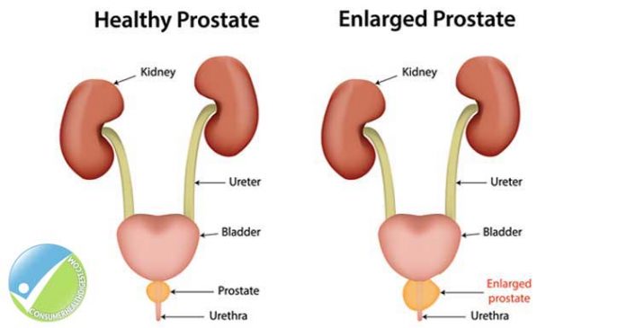 prostate enlargement natural cures