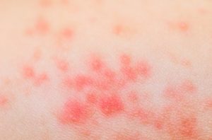rashes