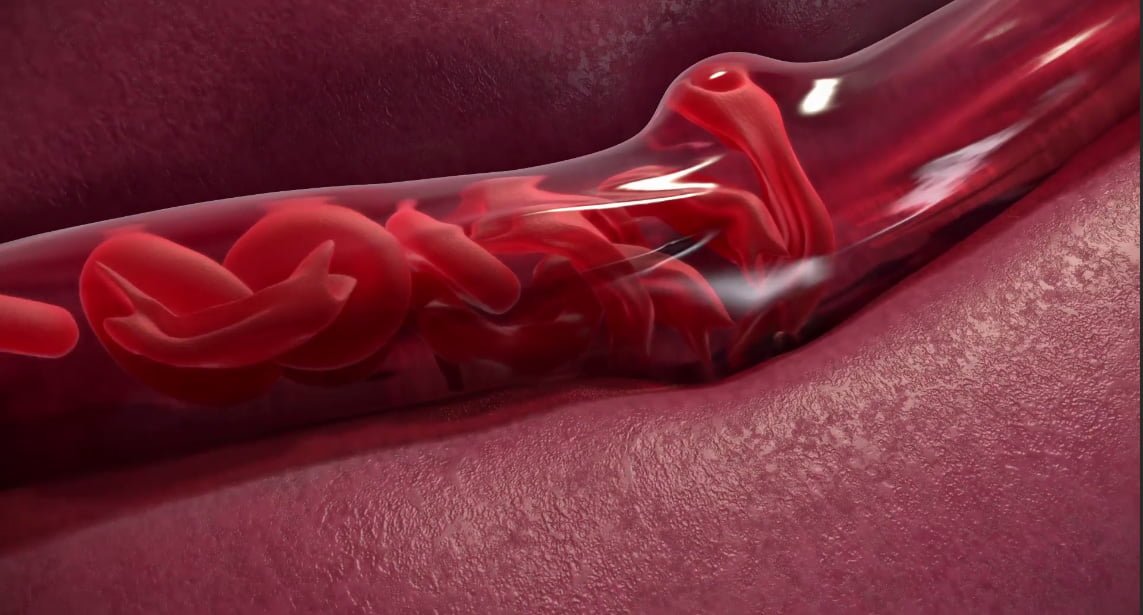 Natural Treatments For Sickle Cell Disease Spinach, Beet Roots And