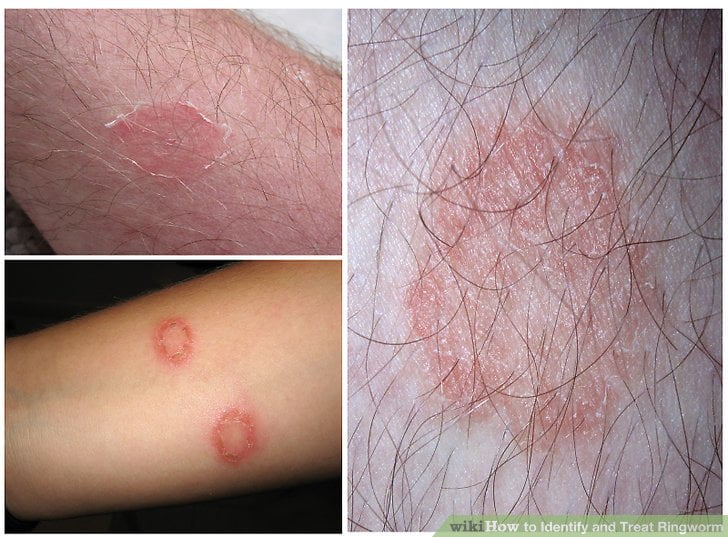 Ringworm Symptoms Causes Complications And Risk Factors