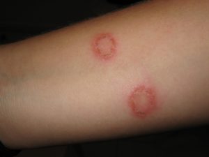 skin infection home remedy