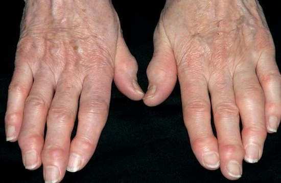 Osteoarthritis symptoms causes