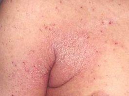 Natural cures for scabies