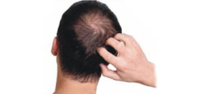 Natural cures for scalp ringworm, scalp ringworm home remedy