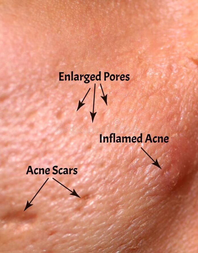 Larged Pores Most Common 4 Symptoms & Causes
